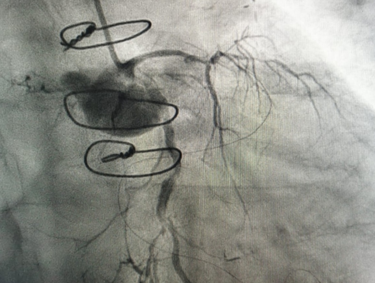 Chennai Cardiologist Perform Complex PCI Procedure On 65-year-old Patient During Worldwide Live Aid Event